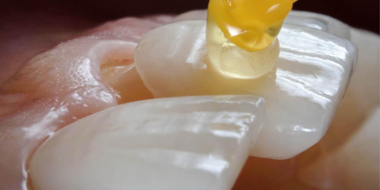 Las Carillas Dentales