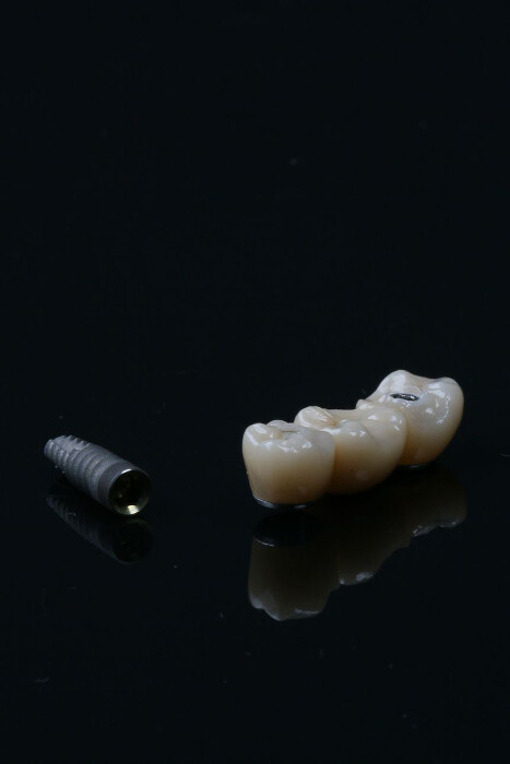 implantes-servicios-revident https://revidentdentalcenter.digitalvp.es/wp-content/uploads/2023/07/implantes-servicios-revident.jpg