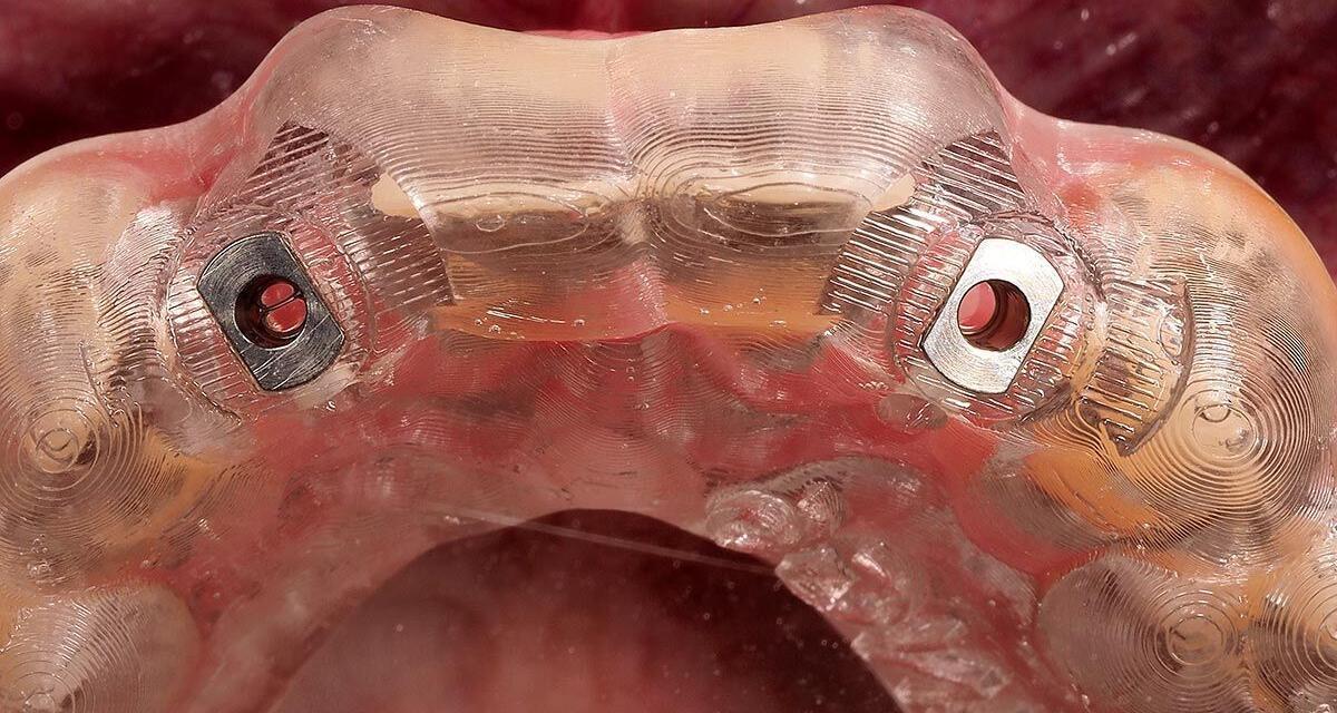 Cirugía Guiada de Implantes Dentales