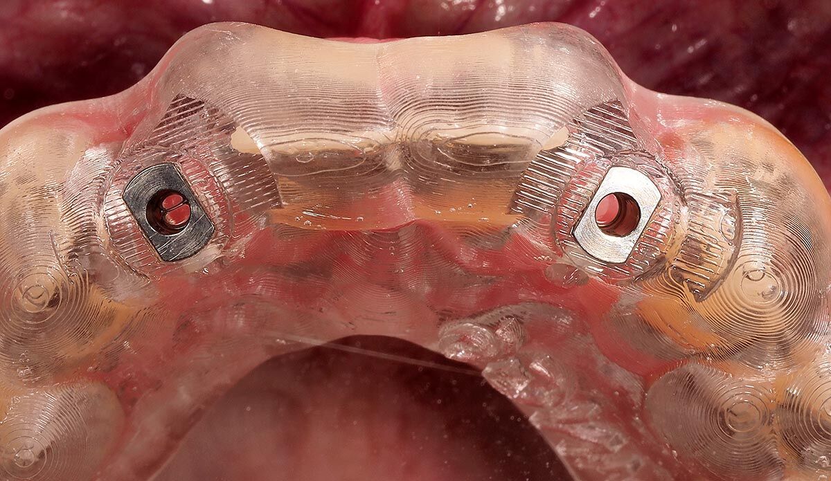 La cirugía guiada para la colocación de implantes utiliza imágenes y guías quirúrgicas impresas en 3D para colocar con precisión el implante dental en la posición correcta sin dañar la estructura natural.