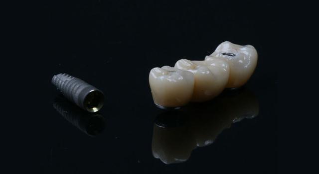 Implantes con cirugía guiada y carga inmediata Implantes con cirugía guiada y carga inmediata