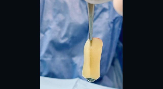 El PRP (PLASMA RICO EN PLAQUETAS) proviene de la misma sangre del paciente El PRP (PLASMA RICO EN PLAQUETAS) proviene de la misma sangre del paciente